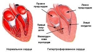 Виды гипертрофии мышц: понятие, способ лечения жевательной и сердечной гипертрофии